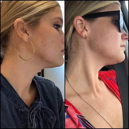 Retinol Serum (2.5%) Anti-Aging Hyaluronic Acid + Vitamin E Reduces Wrinkles, Redness, and Pores 1oz