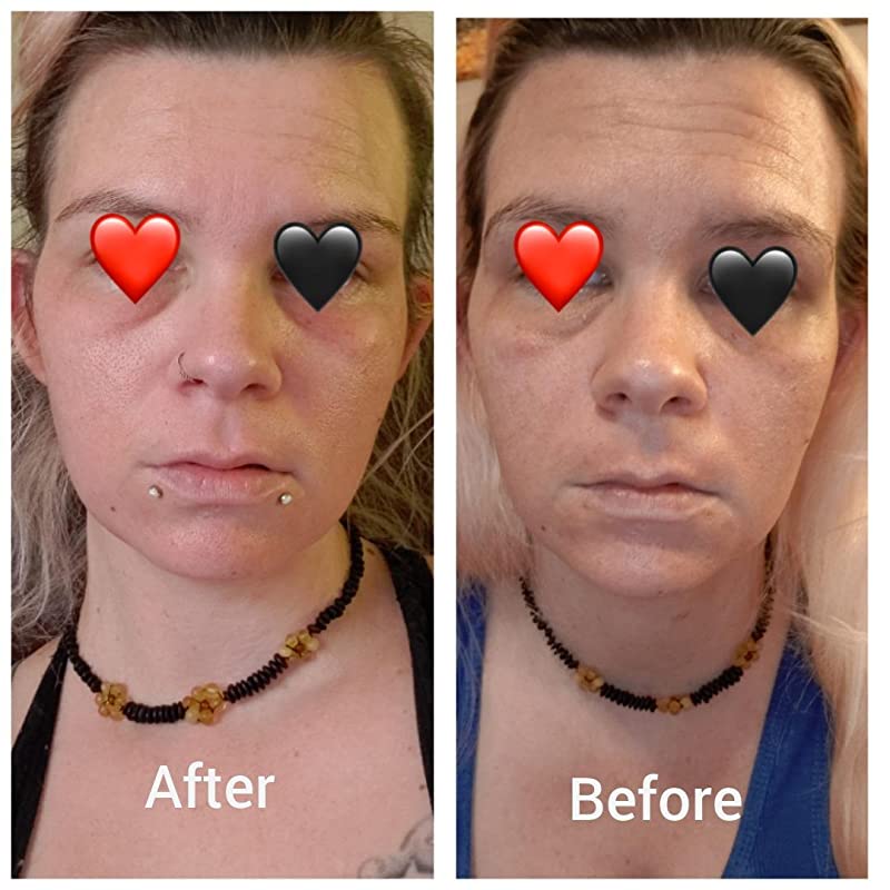 Retinol Serum (2.5%) Anti-Aging Hyaluronic Acid + Vitamin E Reduces Wrinkles, Redness, and Pores 1oz