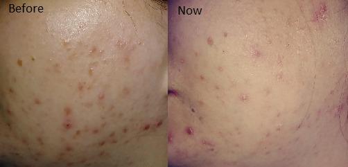 Retinol Serum (2.5%) Anti-Aging Hyaluronic Acid + Vitamin E Reduces Wrinkles, Redness, and Pores 1oz