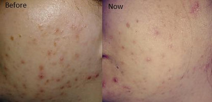 Retinol Serum (2.5%) Anti-Aging Hyaluronic Acid + Vitamin E Reduces Wrinkles, Redness, and Pores 1oz